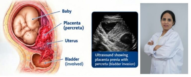 मौत के साये में 36 सप्ताह की हाई-रिस्क प्रेग्नेंसी, प्लेसेंटा पर्क्रेटा केस में मां, नवजात और गर्भाशय तीनों सुरक्षित